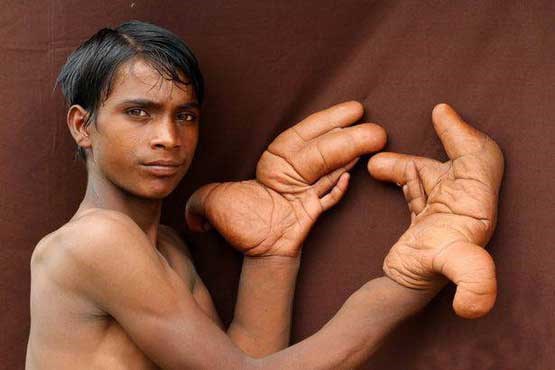 انگشتان غول آسای پسر بچه هندی