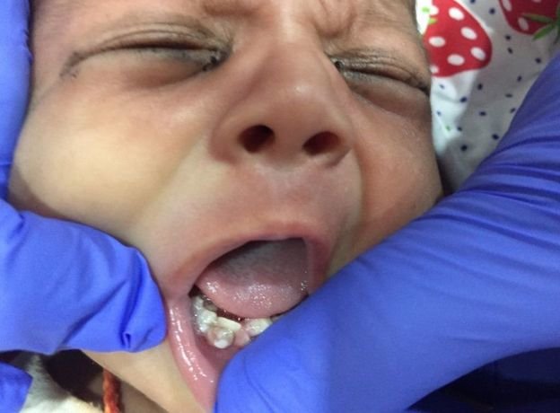 عمل جراحی دندان نوزاد هندی
