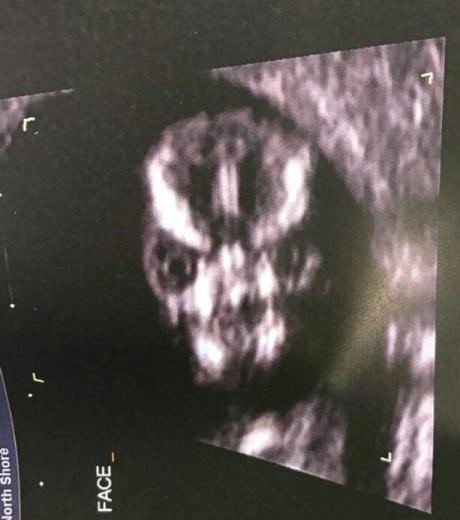 شوکه شدن مادر باردار از چهره جنینش در سونوگرافی