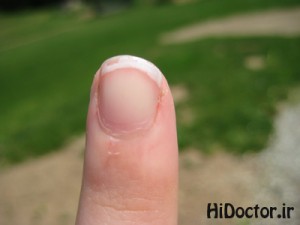 درمان پوسته پوسته شدن نوک انگشتان دست