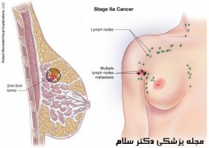 سرطان سینه و غدد لنفاوی و افزایش تومور