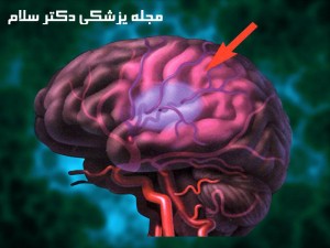 سکته خفیف مغزی | سردرد، سوزش دست و پاها
