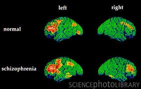 منشا و علل ایجاد بیماری Schizophrenia 1