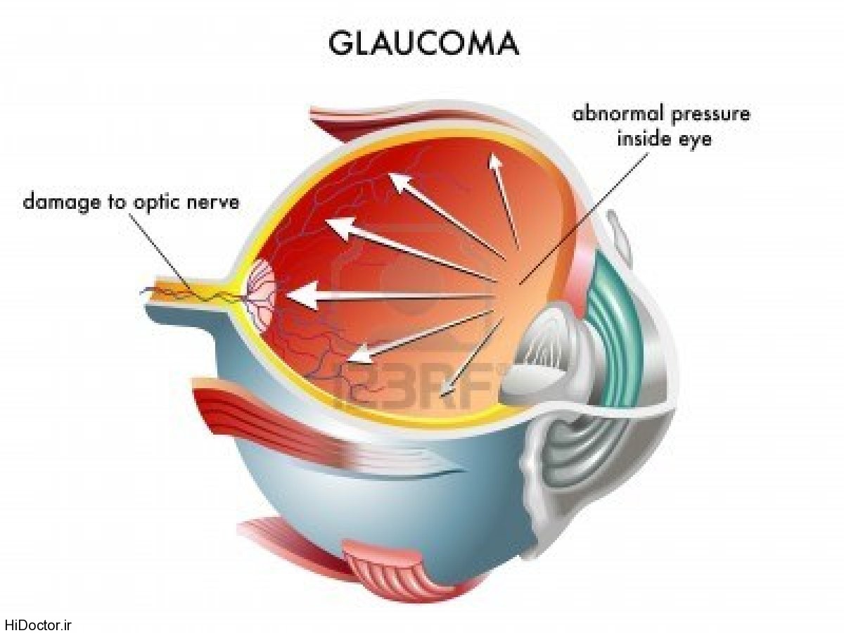 glaucoma_9.jpg