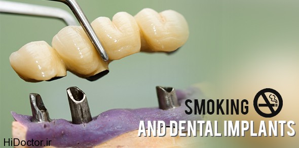 Smoking-And-Dental-Implants.jpg