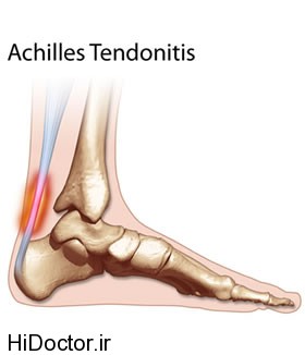 thm-achilles-tendonitis
