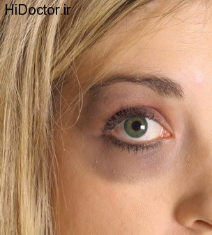 dark-circles-under-eyes-