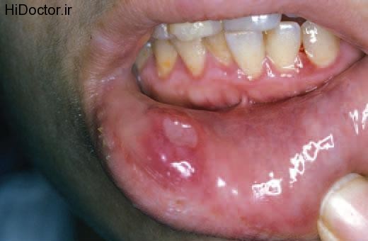 single-oral-aphthous-ulcer