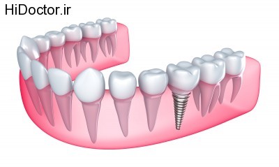 bigstock-Dental-implant-in-the-gum-Is-39560938