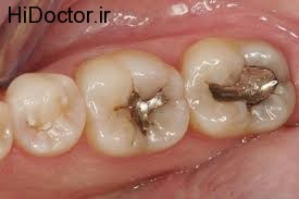 تاثیر نامطلوب پر کردن دندان بر دیگر دندان ها 1