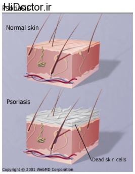 understanding_psoriasis_basics