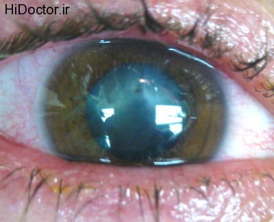 Intraocular-Foreign-Body-1A