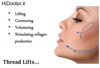 thread-lifts