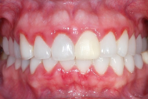 نتیجه تصویری برای عفونت دندان