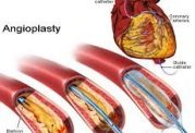 روش آنژیوپلاستی خطرات ناشی از  عوارض آن