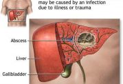 آبسه کبدی - علائم و درمان