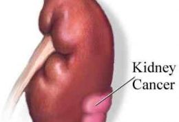 آقایان حواستان به سرطان کلیه باشد
