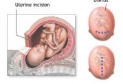 مشکلات جای بخیه پس از سزارین