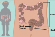 یبوست در سنین پایین