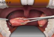 از جراحی لوزه ها بیشتر بدانید