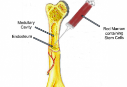 پیوند مغز استخوان برای نجات بیماران سرطانی
