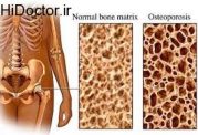 مراقبت های تغذیه ای لازم برای پوکی استخوان