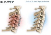 اقدامات درمانی مهم برای مشکل در دیسک گردن