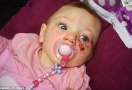 تولد نوزادی با اختلال نادر مغزی