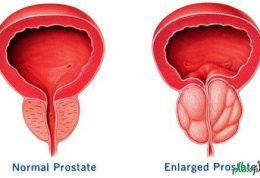 سرطان پروستات با این علائم همراه است