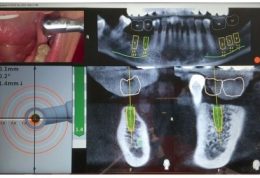 دقیق قرار دادن ایمپلنت با استفاده از هدایت پویا یا نویگیشن دکتر ادیب