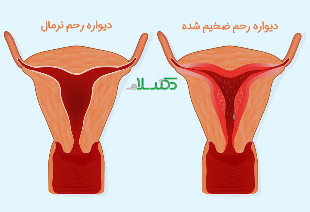 ضخامت دیواره رحم