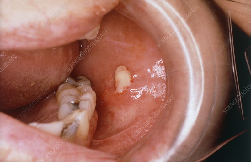 infected-salivary-gland