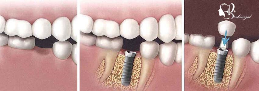 کاشت دندان دائمی | ایمپلنت دندان لیزری
