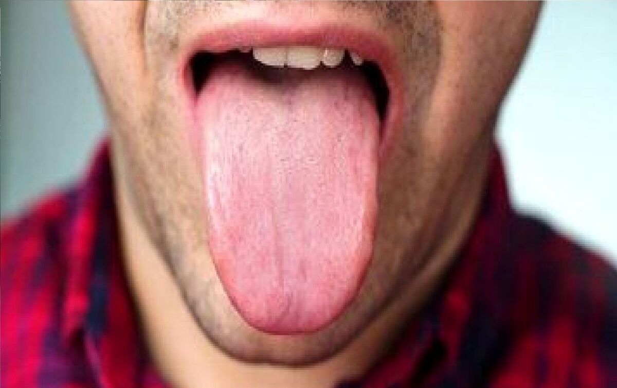کبودی زبان نشانه این بیماری است