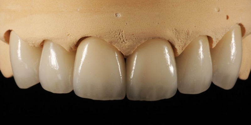 درباره دندان مصنوعی و دندانسازی بیشتر بدانیم