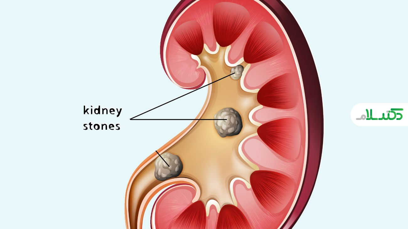 علل، علائم، پیشگیری و درمان سنگ کلیه